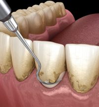 Periodontal Therapy