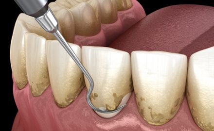 Periodontal Therapy